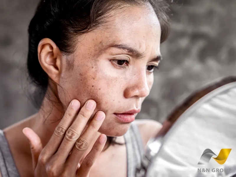 Nguyên nhân khiến da xỉn màu, tối sạm